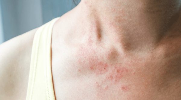 Dealing with Eczema Flare-Ups: Effective Ways to Manage Skin Irritation